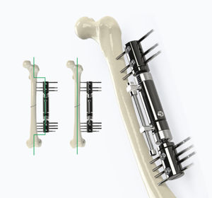 femur external fixation system