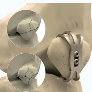 patella compression plate