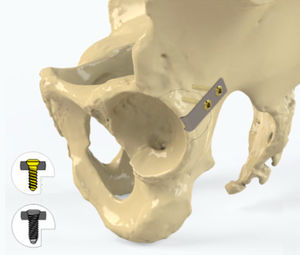 acetabulum compression plate