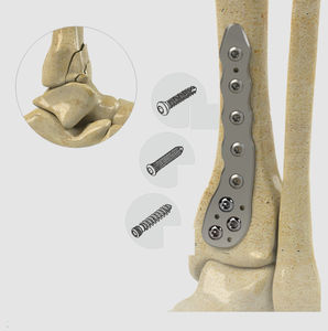 tibia compression plate 1