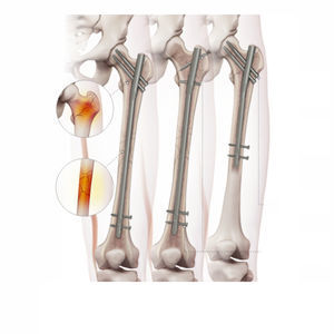 femoral intramedullary nail