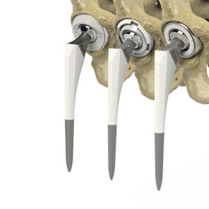 primary hip prosthesis 1