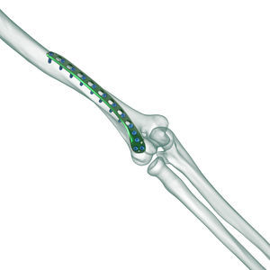 humerus compression plate