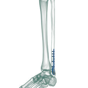 fibula compression plate