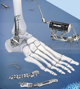 ankle arthrodesis plate