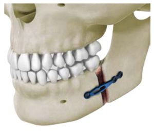 mandible osteotomy plate