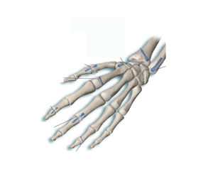 hand phalange compression bone screw