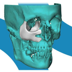 custom-made periorbital implant