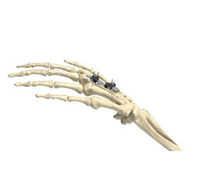 metacarpophalangeal joint external fixation system 1