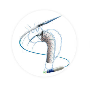 ascending thoracic aorta stent graft