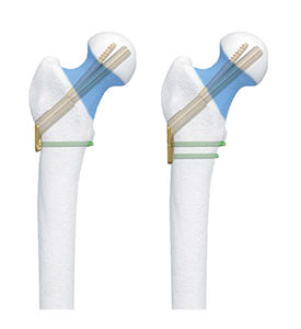 femoral head compression plate