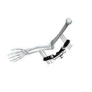 elbow external fixation system