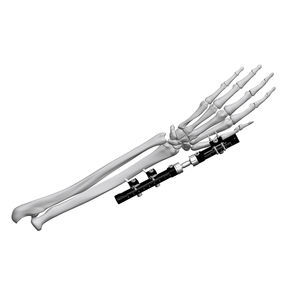 wrist external fixation system