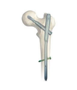 femoral intramedullary nail 1