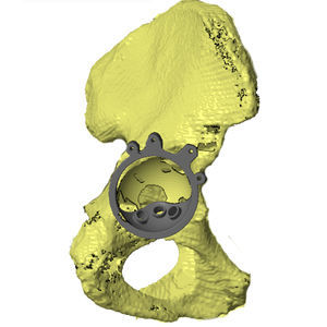 hip prosthesis resection guide