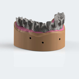 titanium dental prosthesis