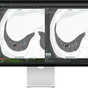 lung cancer screening software