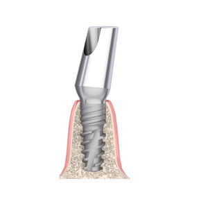 conical implant abutment 1