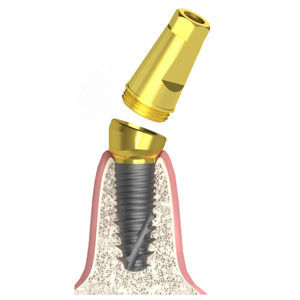 conical implant abutment 1