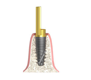 cylindrical implant abutment 1