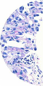 lung cancer test kit