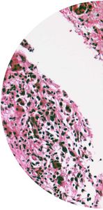 glioma test kit