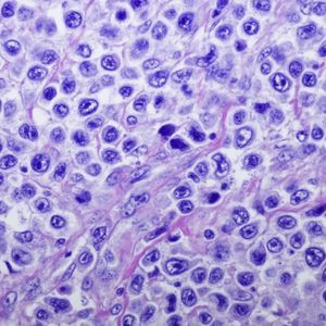 lymphoma test kit