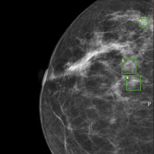 breast cancer screening software