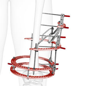 tibia external fixation system 1