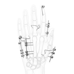 metacarpophalangeal joint external fixation system 1