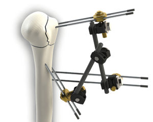 humerus external fixation system 1