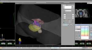 brachytherapy software
