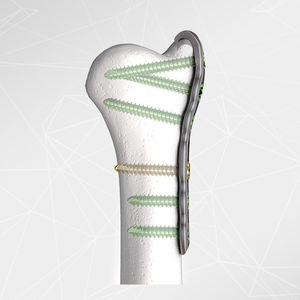 ulna compression plate