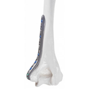 humerus compression plate