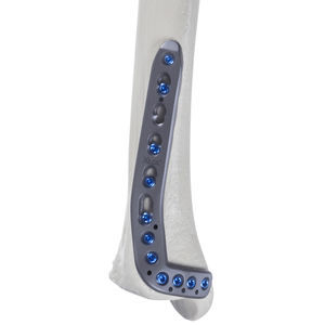 tibia compression plate 1