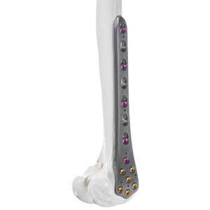 femur compression plate 1