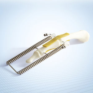 metatarsophalangeal joint external fixation system