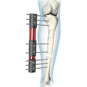 Orthopedic Instrument Trauma Tibial External Fixator System for Tibia  Fracture - China Synth External Fixation, External Fixator