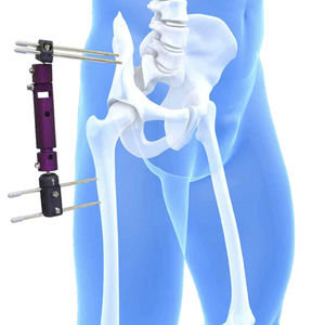 pelvis external fixation system