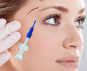 skin closure surgery tissue adhesive