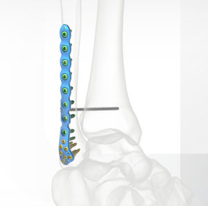 fibula compression plate