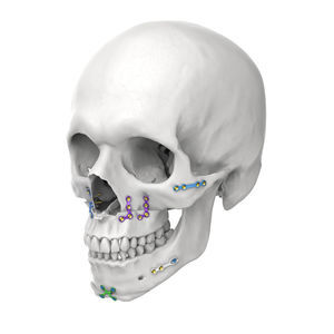 genioplasty compression plate