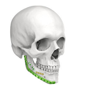 mandible compression plate