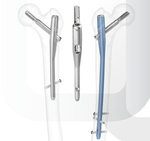 femoral intramedullary nail