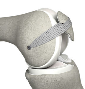 Anterior cruciate ligament ligament prosthesis - JewelACL ...