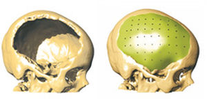 custom-made cranial implant