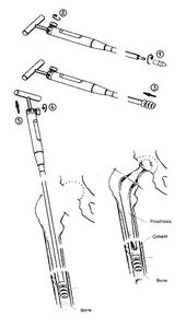 femoral diaphyseal restrictor