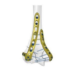 humeral compression plate 1