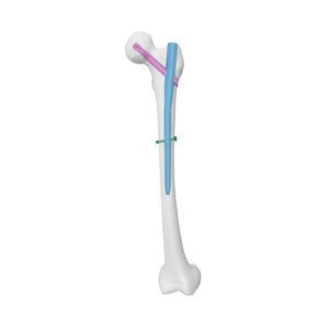 femoral intramedullary nail 1