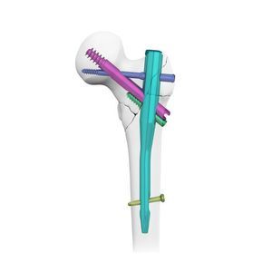 femoral intramedullary nail 1